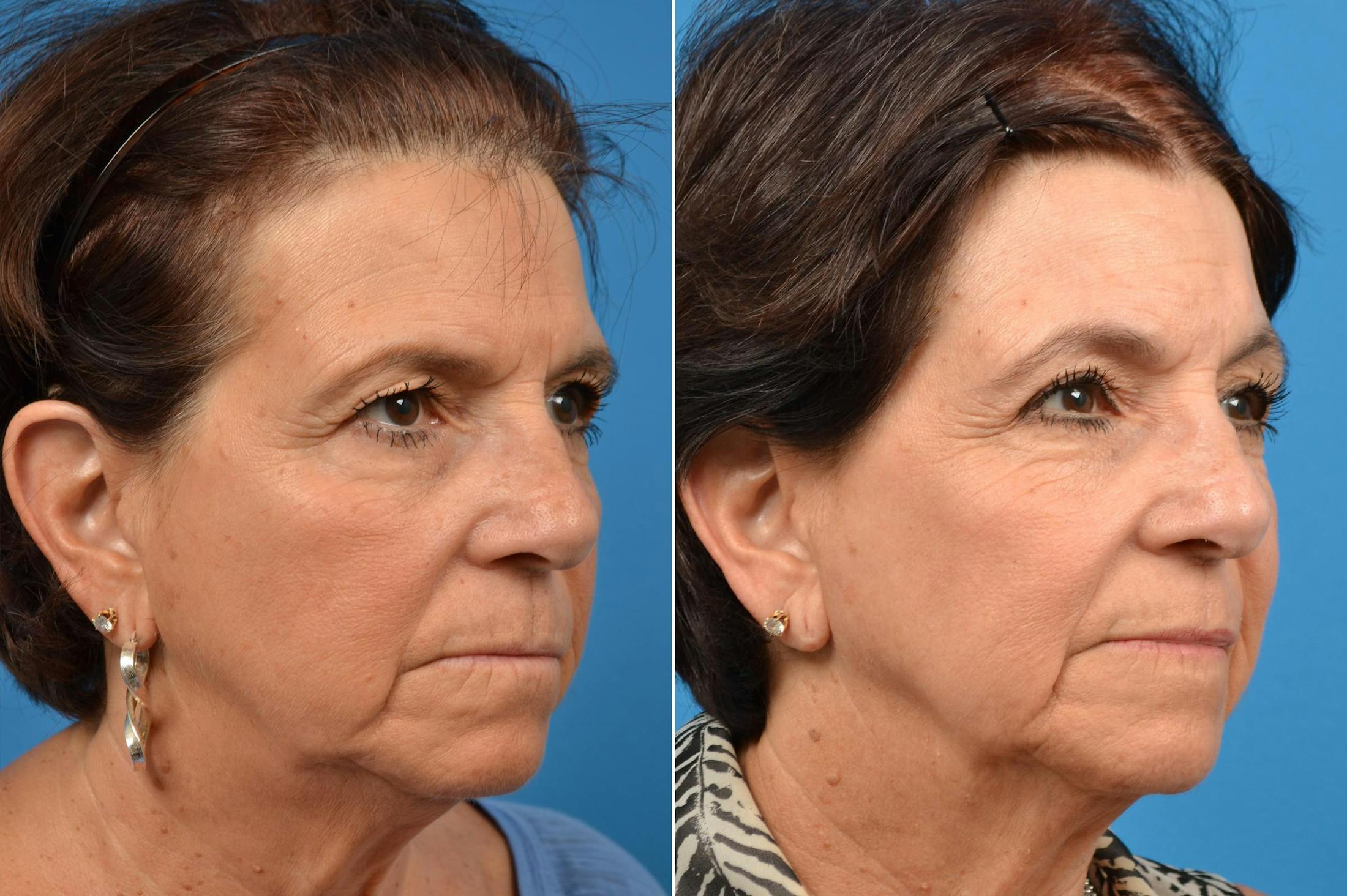 Brow Lift Before & After Gallery - Patient 122405487 - Image 4