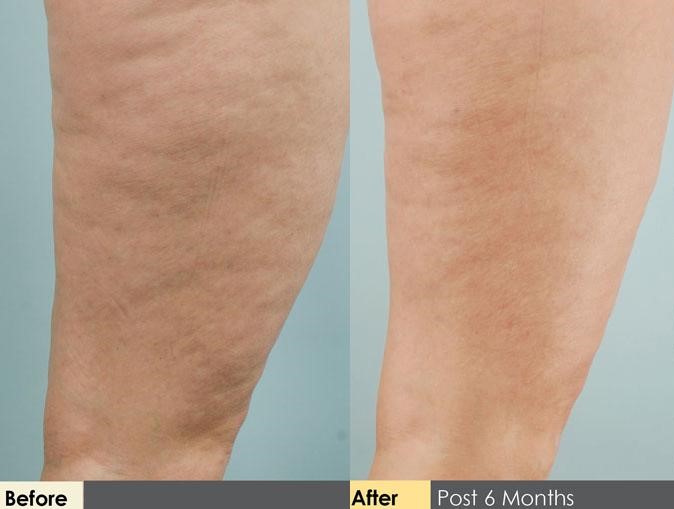 Hidden Cellulite Reduction Before & After Gallery - Patient 122405483 - Image 1