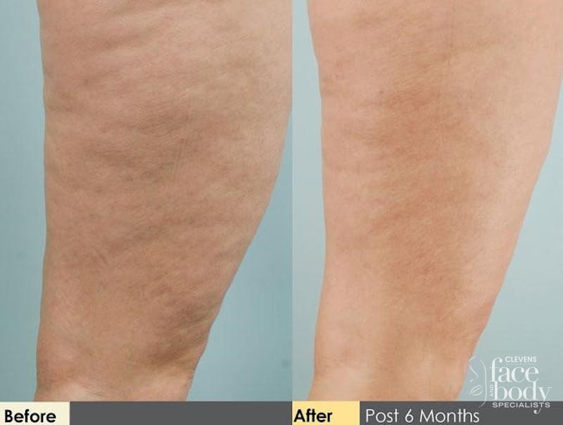 Hidden Cellulite Reduction Before & After Gallery - Patient 122405483 - Image 1