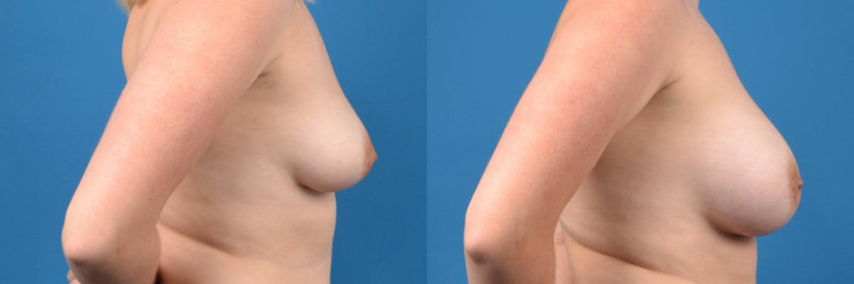 Breast Augmentation Before & After Gallery - Patient 342833 - Image 2