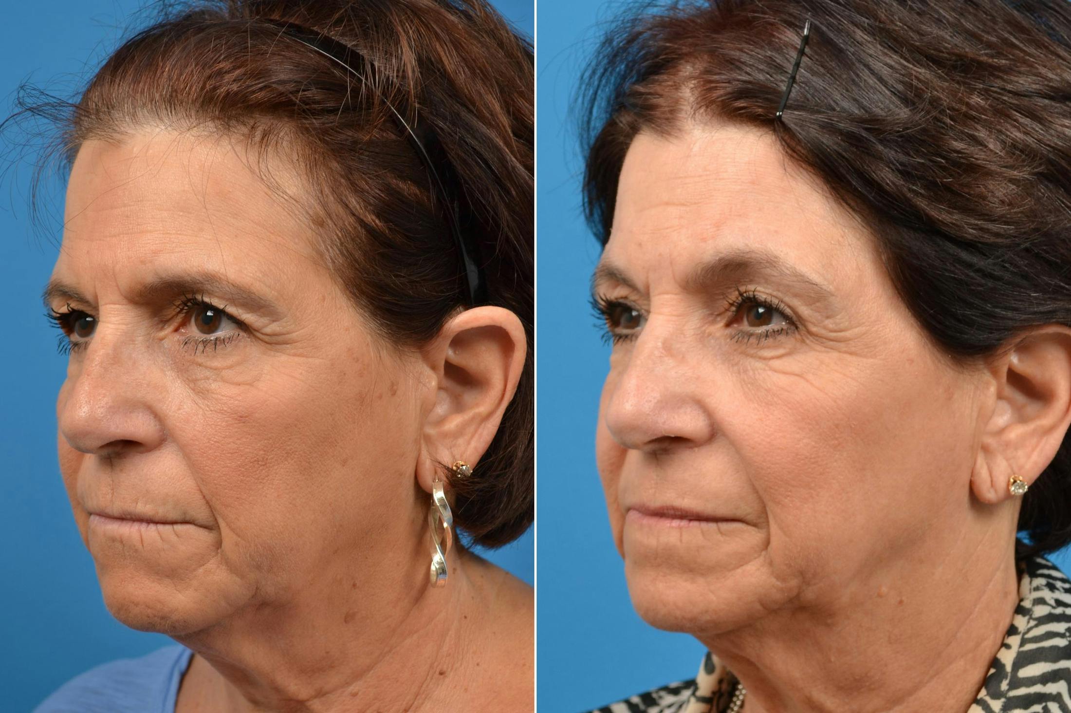 Brow Lift Before & After Gallery - Patient 122405487 - Image 5