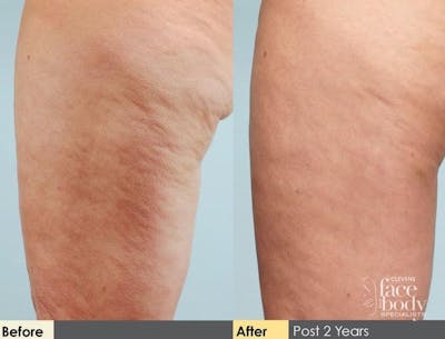 Hidden Cellulite Reduction Before & After Gallery - Patient 122405486 - Image 1