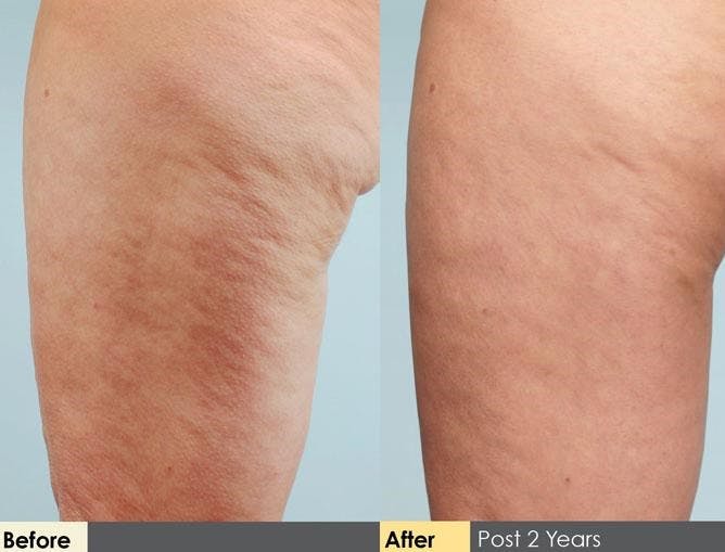 Cellulite Reduction Before & After Gallery - Patient 122405486 - Image 1