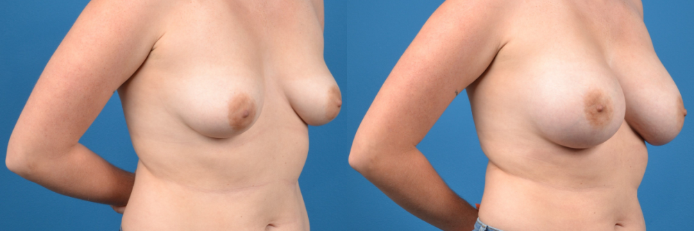 Hidden Breast Aug Before & After Gallery - Patient 244381 - Image 3
