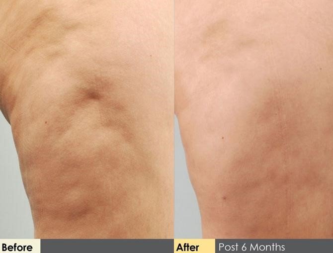 Hidden Cellulite Reduction Before & After Gallery - Patient 122405488 - Image 1