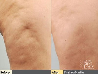 Hidden Cellulite Reduction Before & After Gallery - Patient 122405488 - Image 1
