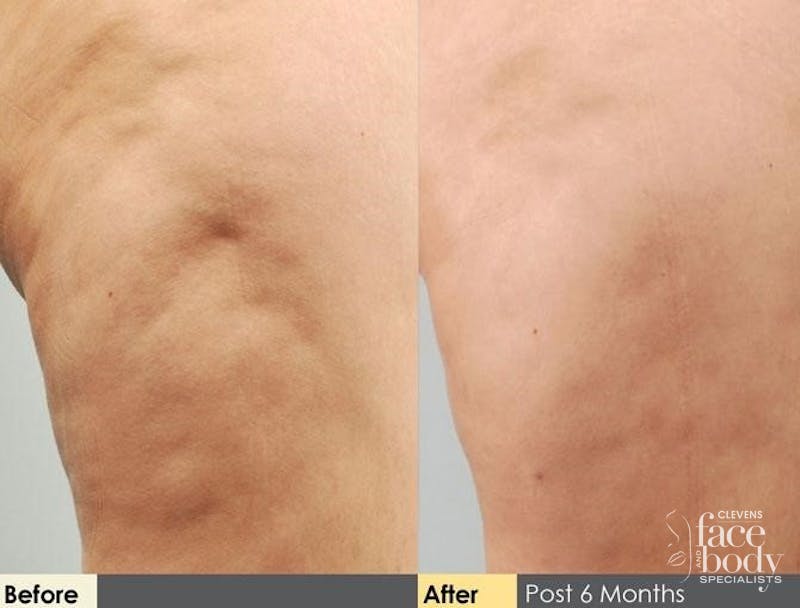 Hidden Cellulite Reduction Before & After Gallery - Patient 122405488 - Image 1