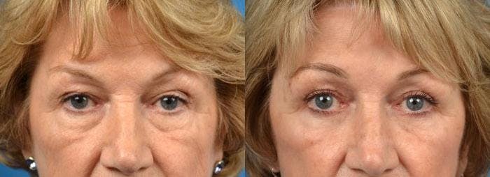 Brow Lift Before & After Gallery - Patient 122405494 - Image 1