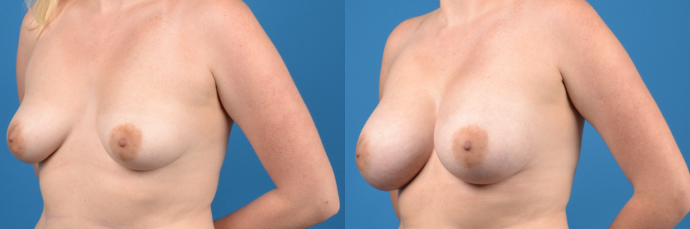 Hidden Breast Aug Before & After Gallery - Patient 244381 - Image 4