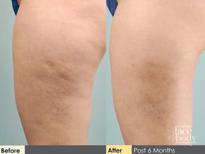Hidden Cellulite Reduction Before & After Gallery - Patient 122405491 - Image 1