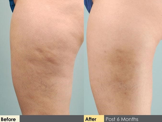Cellulite Reduction Before & After Gallery - Patient 122405491 - Image 1