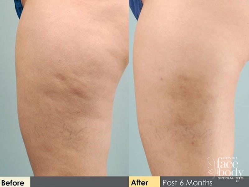 Hidden Cellulite Reduction Before & After Gallery - Patient 122405491 - Image 1