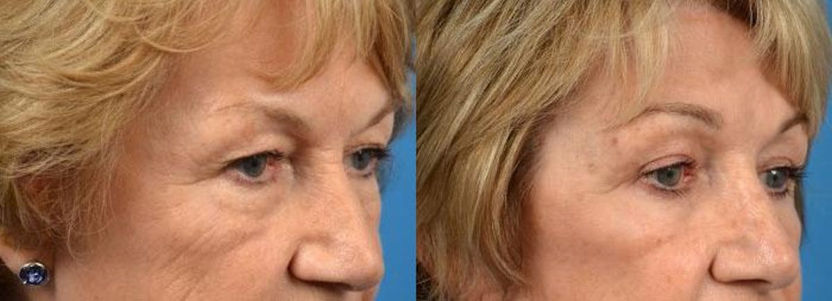 Brow Lift Before & After Gallery - Patient 122405494 - Image 2