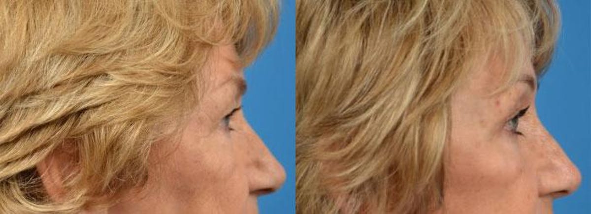 Brow Lift Before & After Gallery - Patient 122405494 - Image 3