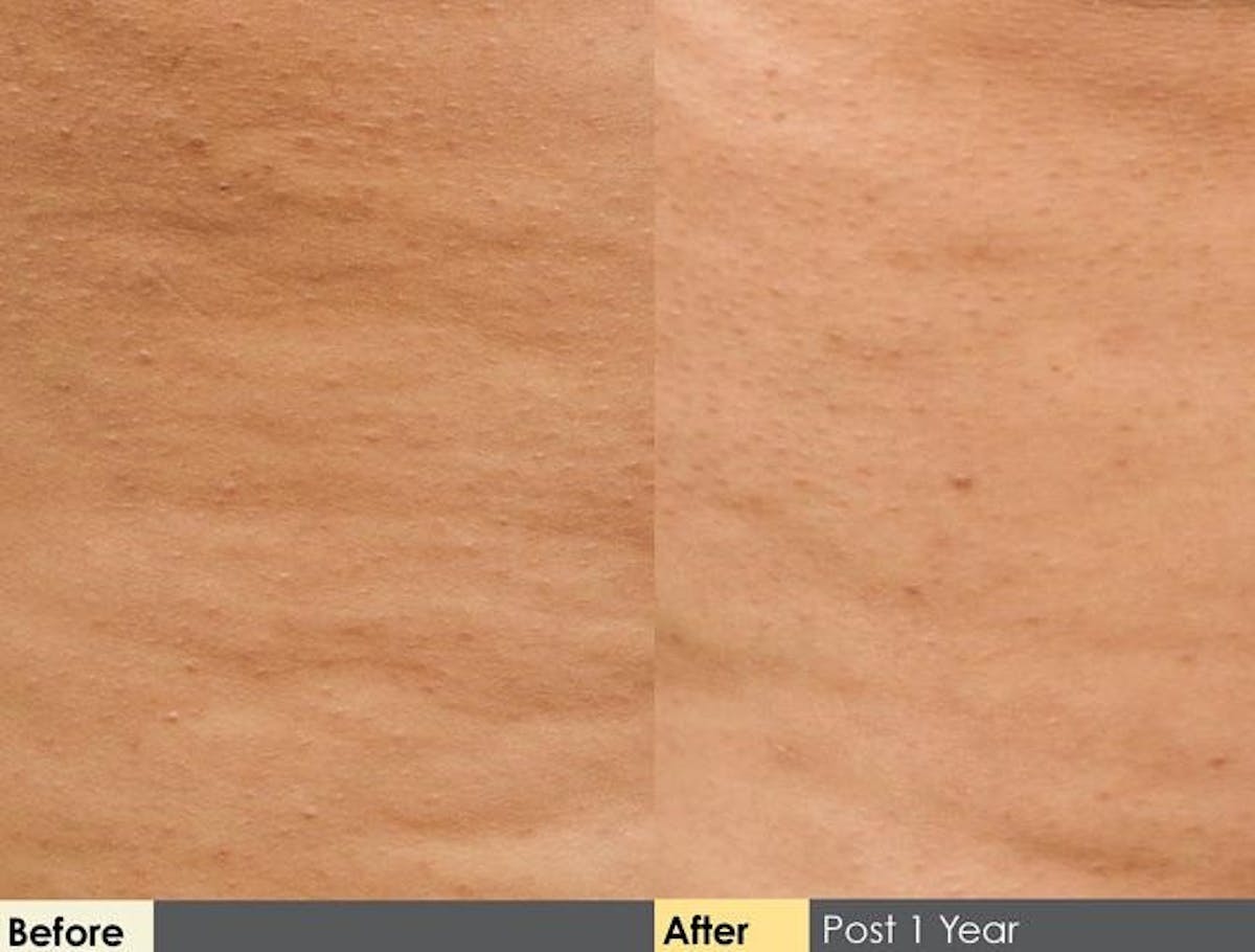 Cellulite Reduction Before & After Gallery - Patient 122405492 - Image 1