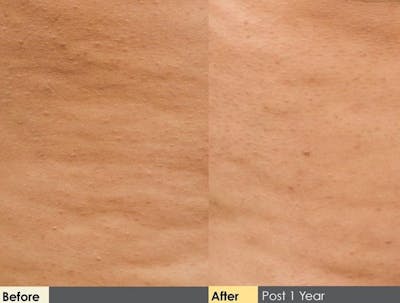 Cellulite Reduction Before & After Gallery - Patient 122405492 - Image 1