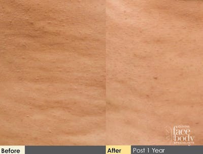Hidden Cellulite Reduction Before & After Gallery - Patient 122405492 - Image 1