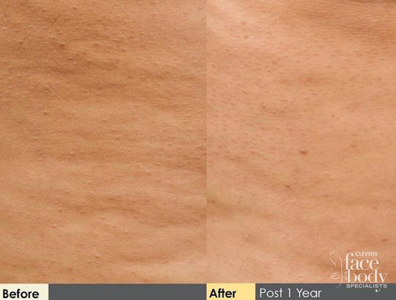 Hidden Cellulite Reduction Before & After Gallery - Patient 122405492 - Image 1