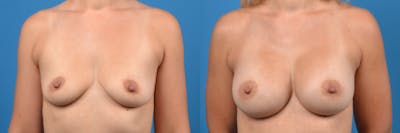 Breast Augmentation Before & After Gallery - Patient 122405497 - Image 1