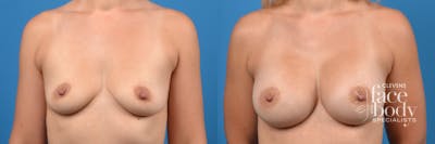 Hidden Breast Aug Before & After Gallery - Patient 270565 - Image 1