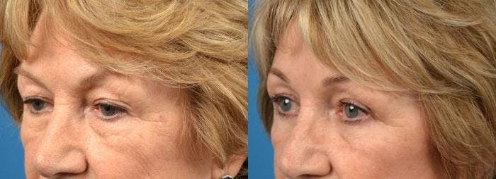 Brow Lift Before & After Gallery - Patient 122405494 - Image 4