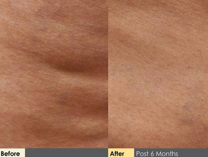 Hidden Cellulite Reduction Before & After Gallery - Patient 122405493 - Image 1