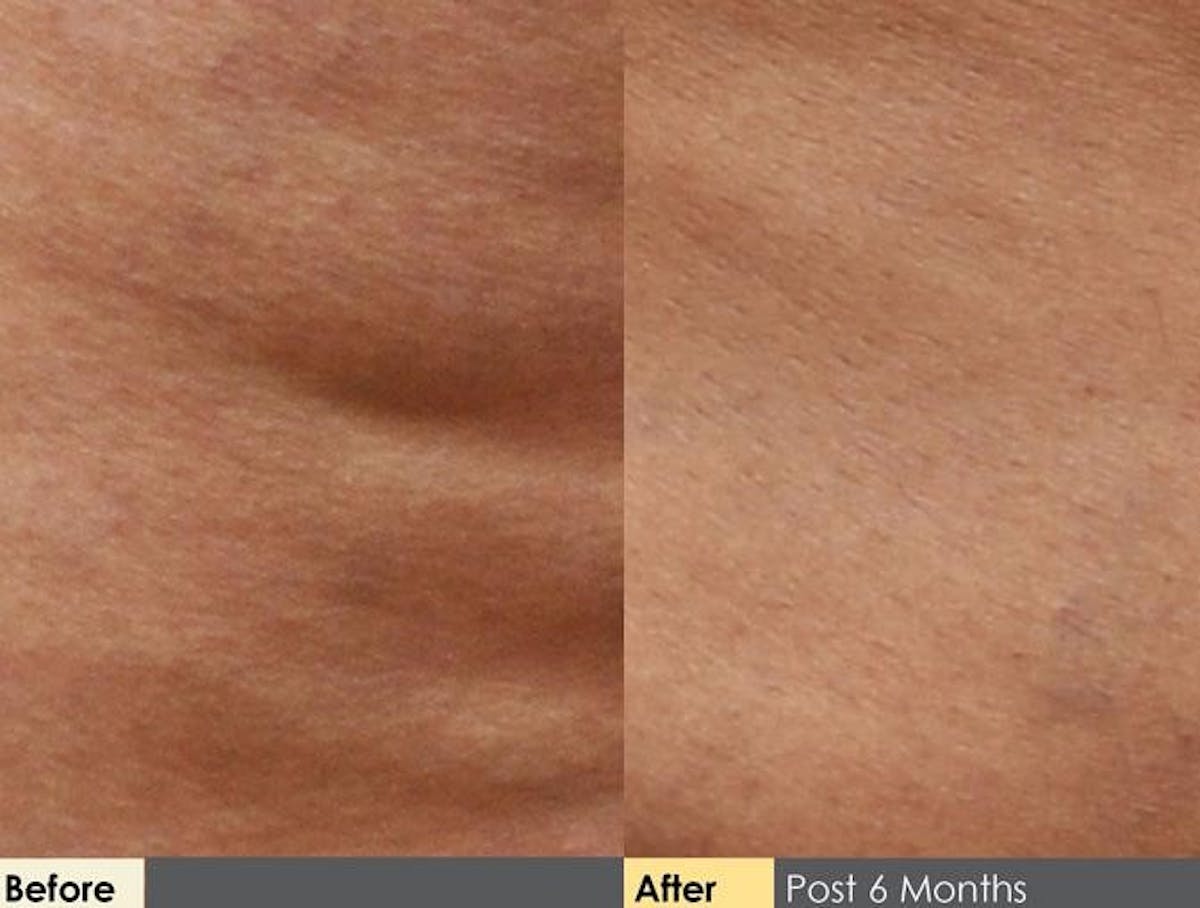 Cellulite Reduction Before & After Gallery - Patient 122405493 - Image 1