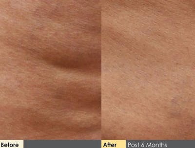 Cellulite Reduction Before & After Gallery - Patient 122405493 - Image 1