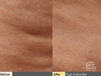 Hidden Cellulite Reduction Before & After Gallery - Patient 122405493 - Image 1