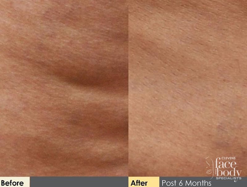 Hidden Cellulite Reduction Before & After Gallery - Patient 122405493 - Image 1