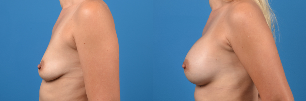 Hidden Breast Aug Before & After Gallery - Patient 351442 - Image 2