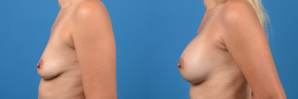 Breast Augmentation Gallery - Patient 122405497 - Image 2