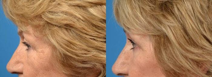 Brow Lift Before & After Gallery - Patient 122405494 - Image 5