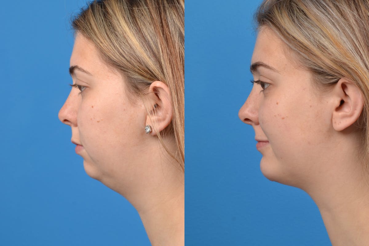 Chin Augmentation Before & After Gallery - Patient 122405498 - Image 1