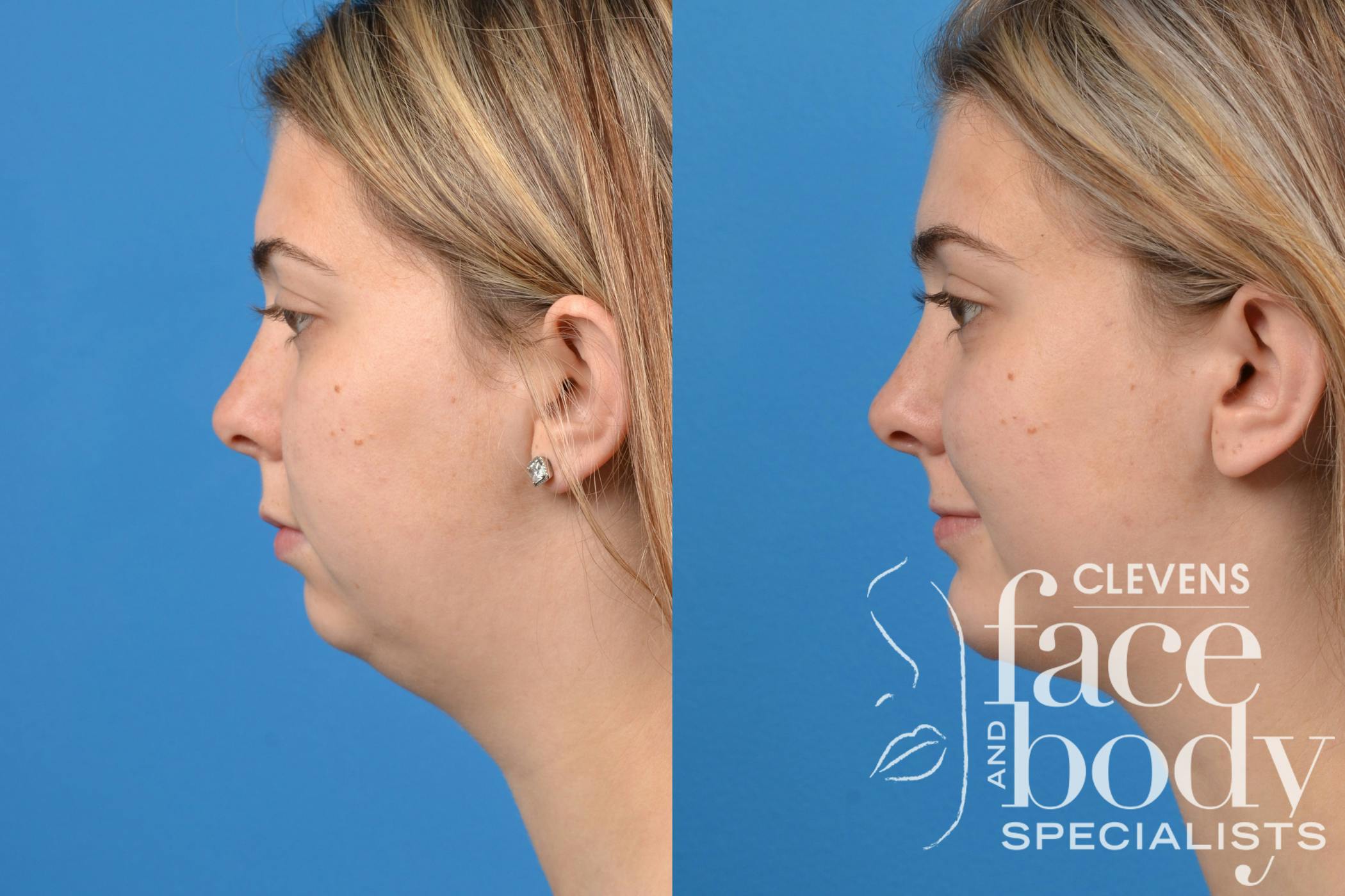 Chin Augmentation