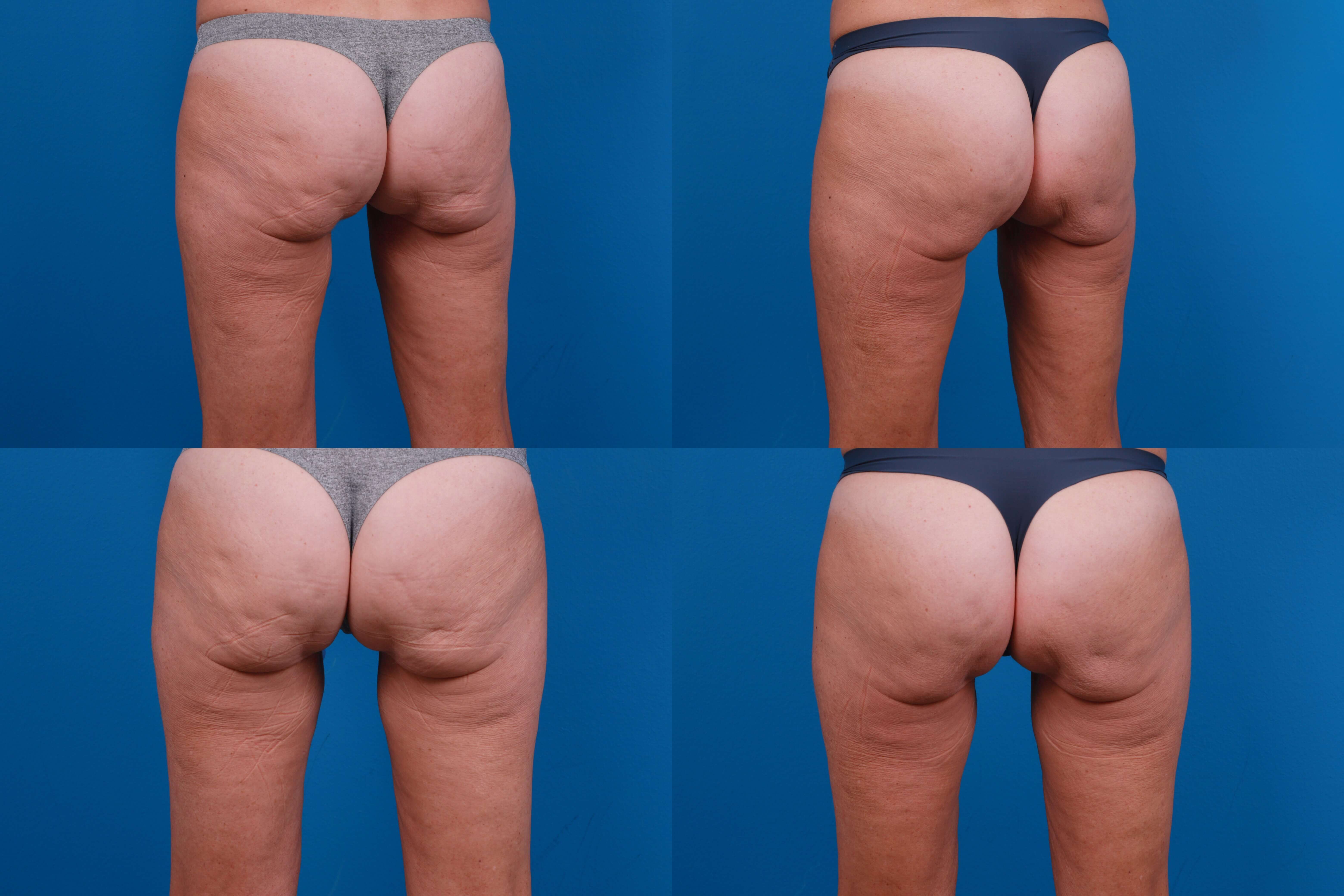 Hidden Cellulite Reduction Before & After Gallery - Patient 122405496 - Image 1