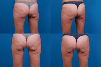 Cellulite Reduction Before & After Gallery - Patient 122405496 - Image 1