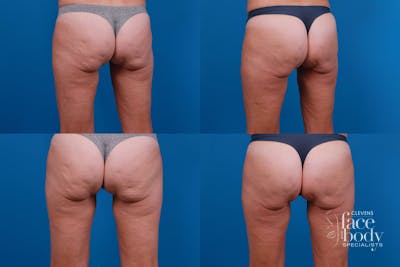 Hidden Cellulite Reduction Before & After Gallery - Patient 122405496 - Image 1