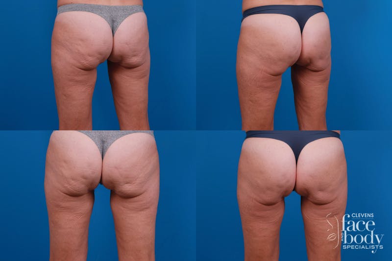 Hidden Cellulite Reduction Before & After Gallery - Patient 122405496 - Image 1