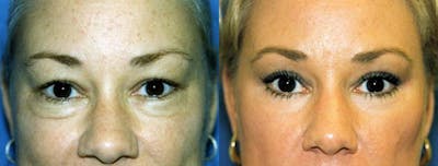 Brow Lift Before & After Gallery - Patient 122405495 - Image 1