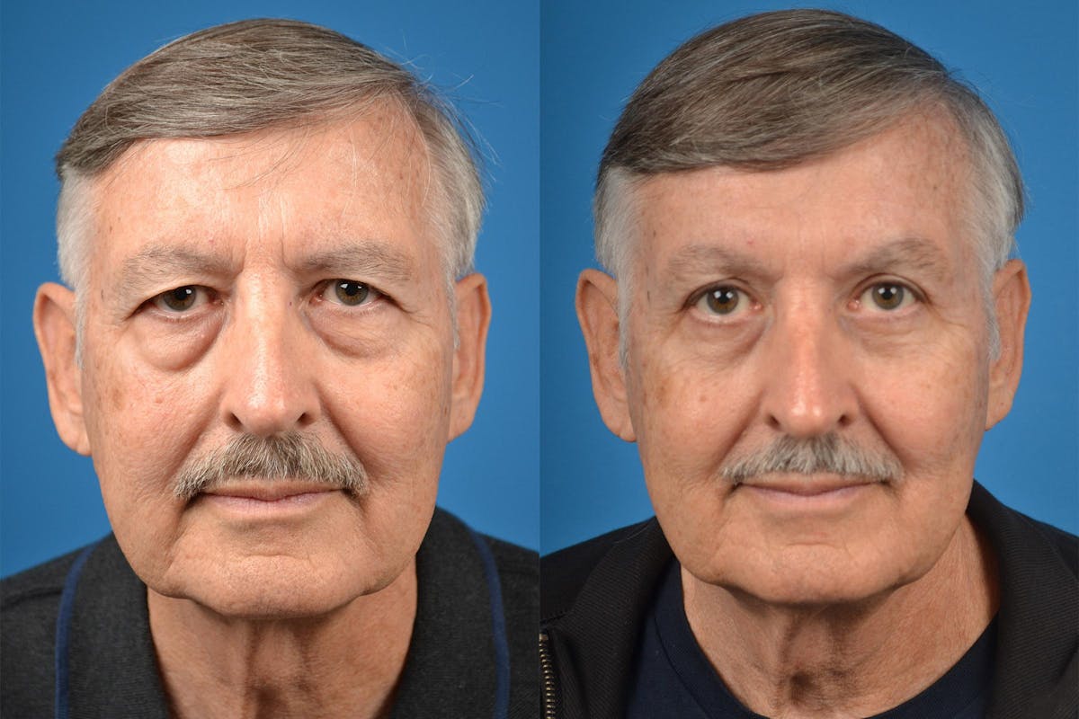 Brow Lift Before & After Gallery - Patient 122405499 - Image 1