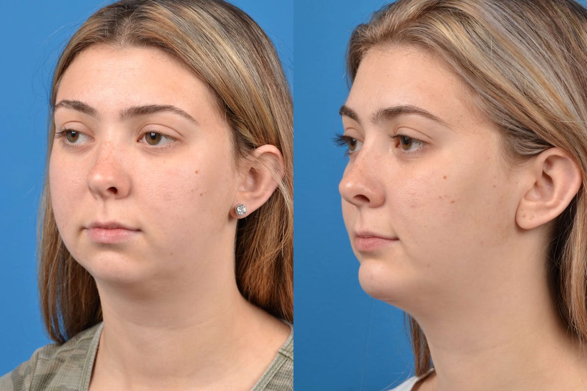 Chin Augmentation Before & After Gallery - Patient 122405498 - Image 2