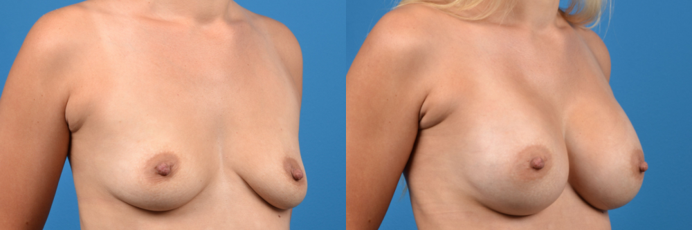 Hidden Breast Aug Before & After Gallery - Patient 351442 - Image 5