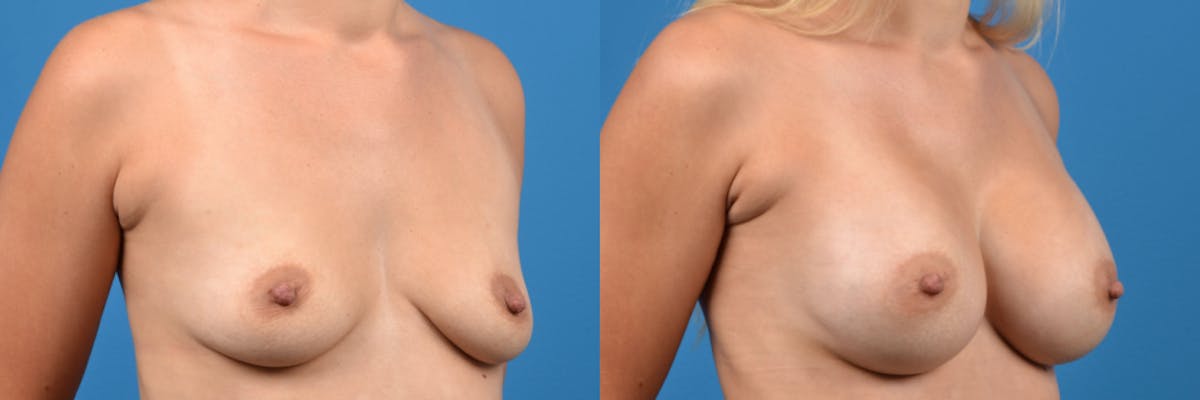 Breast Augmentation Before & After Gallery - Patient 332449 - Image 5