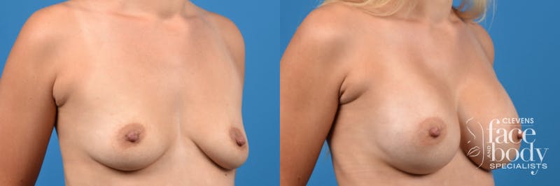 Hidden Breast Aug Before & After Gallery - Patient 351442 - Image 5