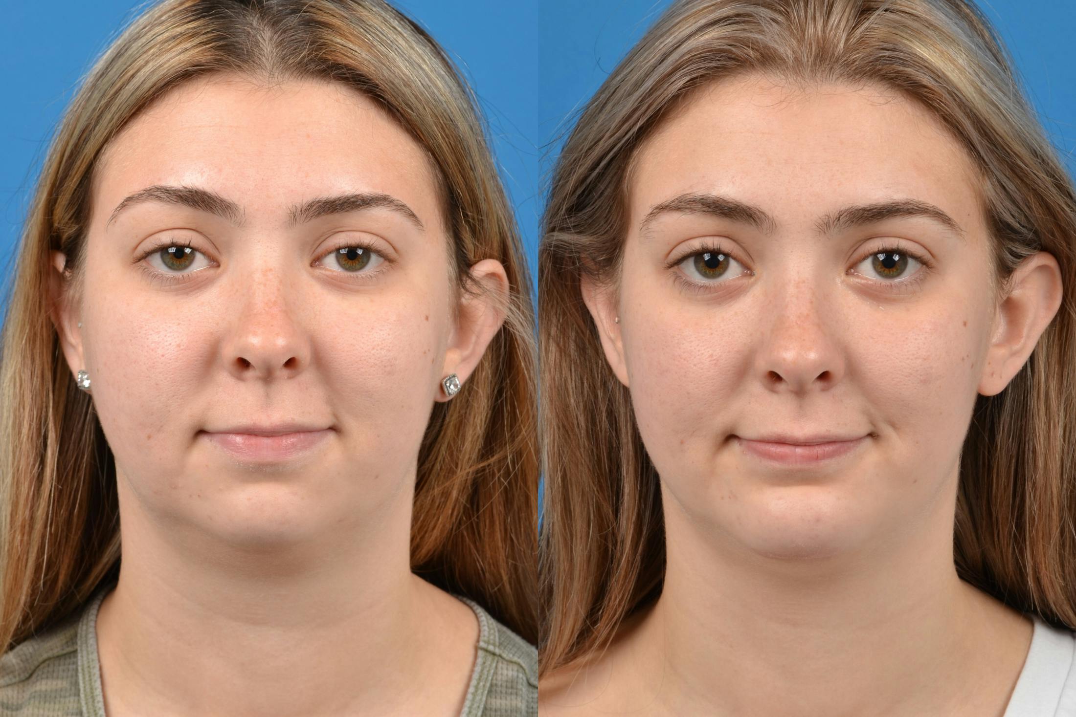 Chin Augmentation Before & After Gallery - Patient 122405498 - Image 3
