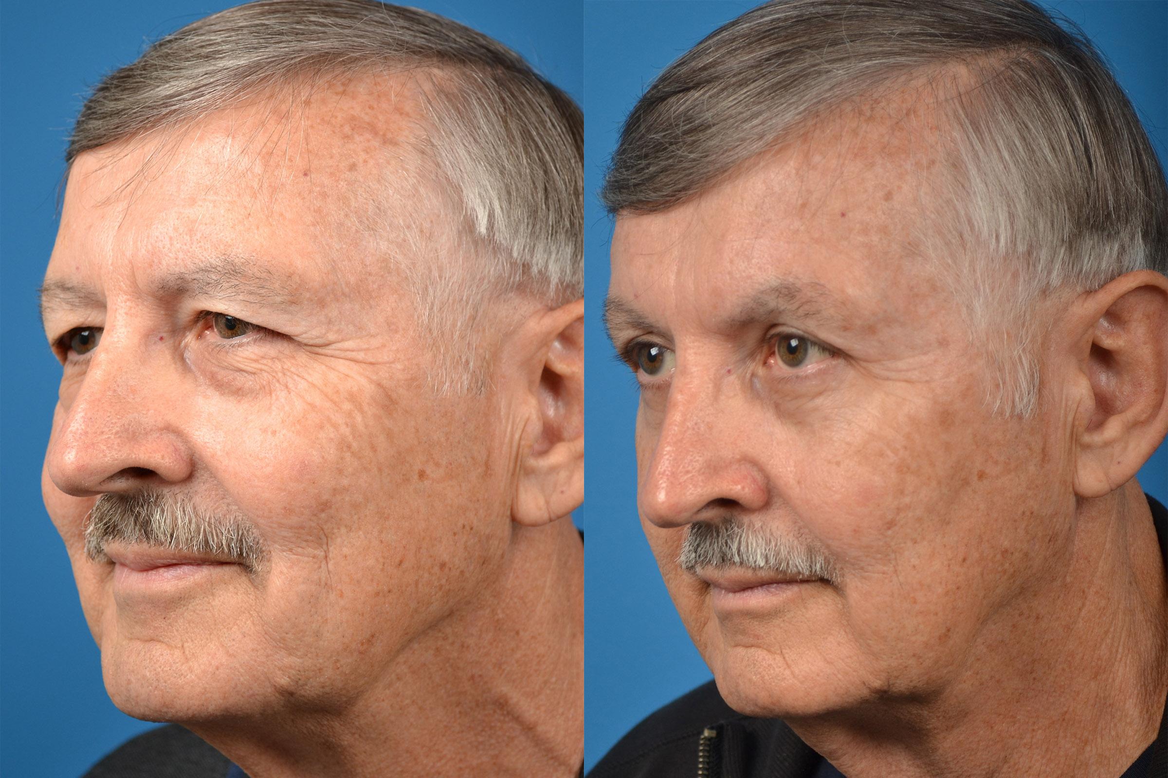 Brow Lift Before & After Gallery - Patient 122405499 - Image 4
