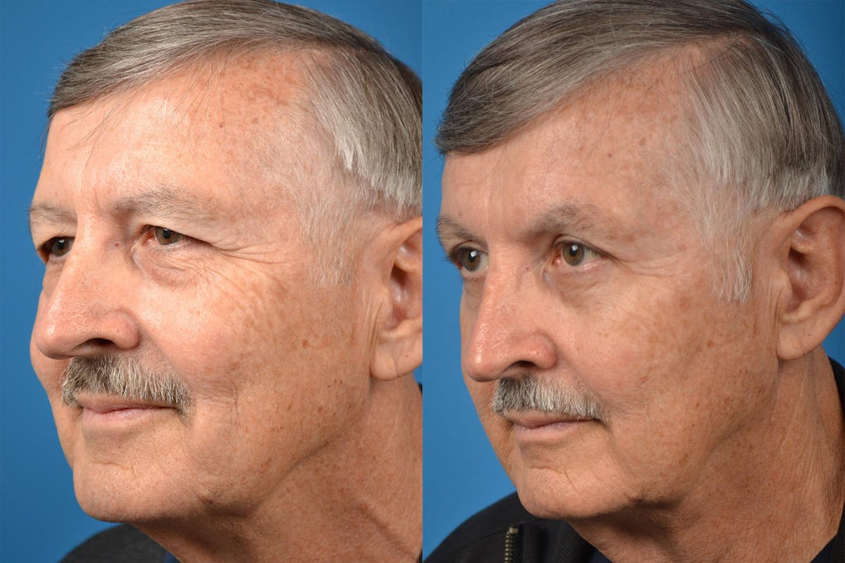 Brow Lift Before & After Gallery - Patient 122405499 - Image 4