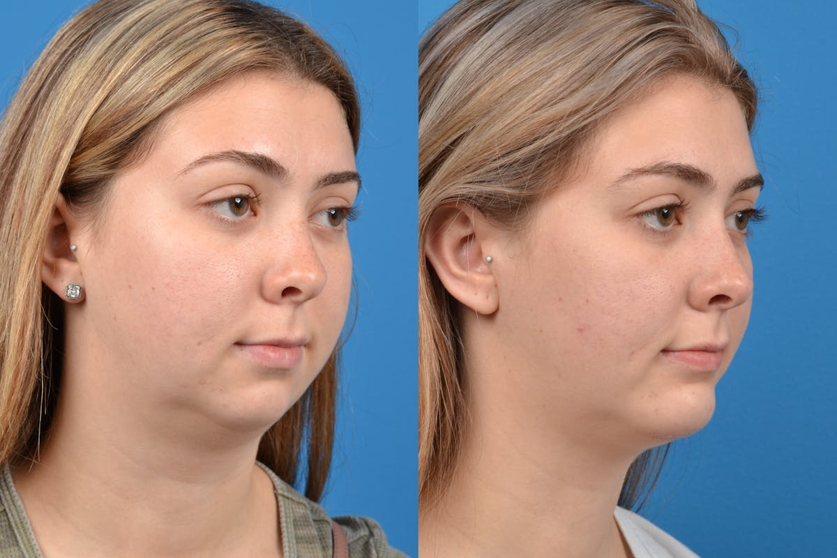 Chin Augmentation Before & After Gallery - Patient 122405498 - Image 4