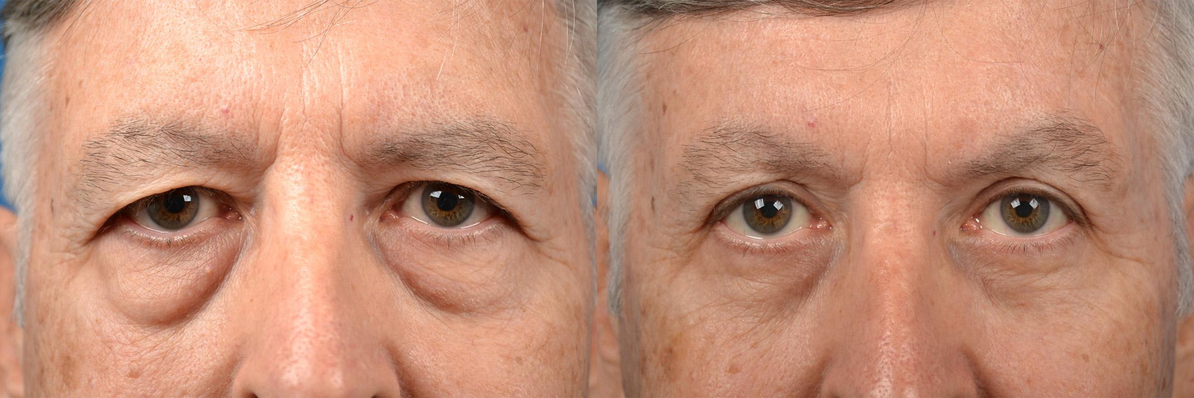 Brow Lift Before & After Gallery - Patient 122405499 - Image 6